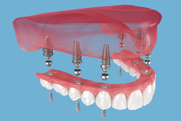 Essential Things To Know About All On Dental Implants